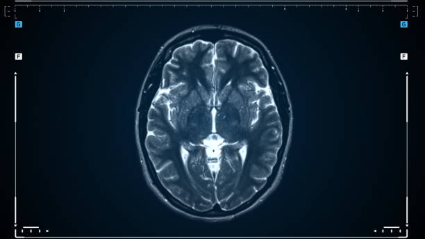 Dementia Detection with CNNs